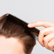 Image for article titled Scientists Are Working on New and Improved Hair Loss Treatments